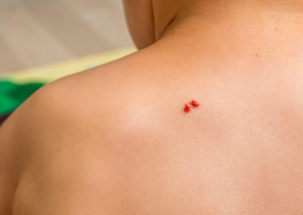 удаление гемангиомы