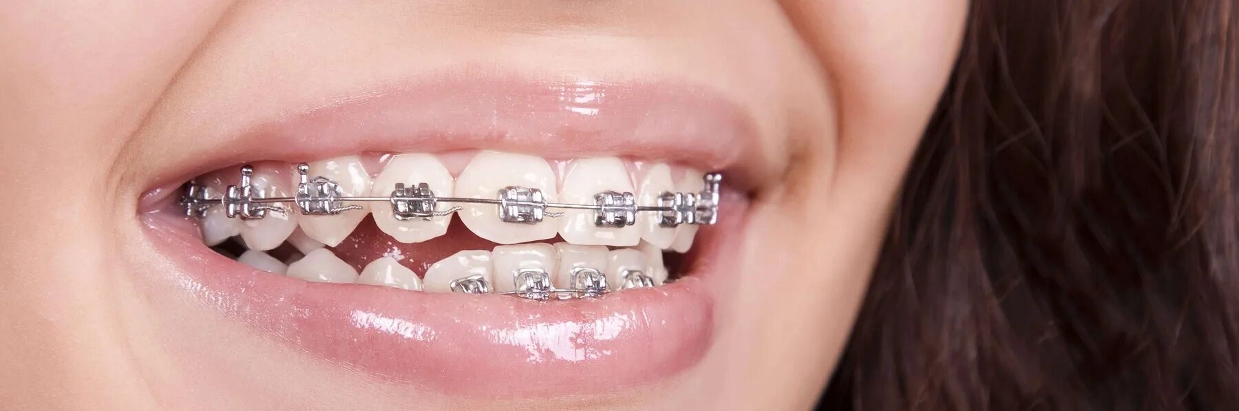 металлические брекеты