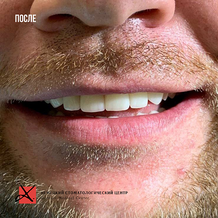 Эстетическое протезирование фронтальных зубов