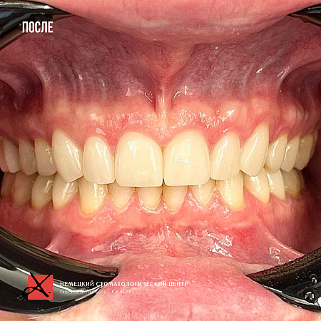 Комплексное гнатологическое лечение