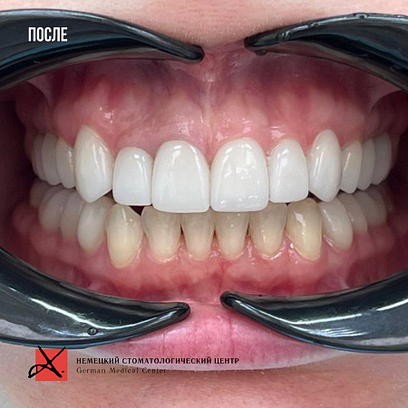 Комплексное гнатологическое лечение и протезирование