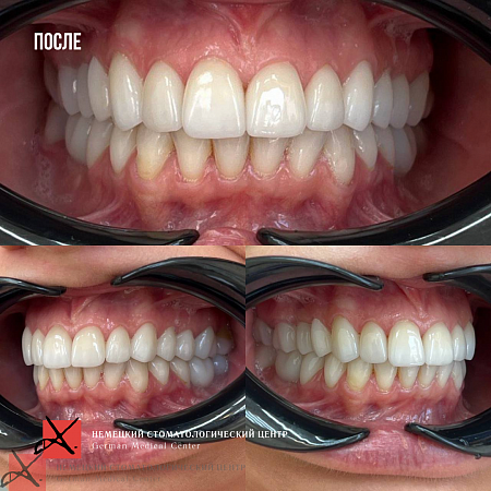 Перелечивание ортодонтического лечения